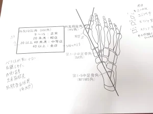 外反母趾の資料